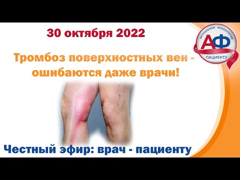 15 минут о тромбозе поверхностных вен - ошибки врачей