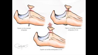 Fractura de coronoides de codo asistida por Artroscopia