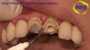 Using Traxodent® paste for gingival retraction