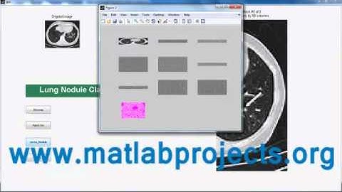 Image Processing Projects | Lung Nodule Classification