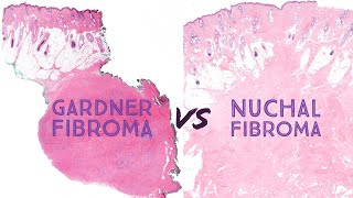 Gardner fibroma vs Nuchal-type fibroma (Emory 7-8) Gardner syndrome, familial adenomatous polyposis screenshot 1