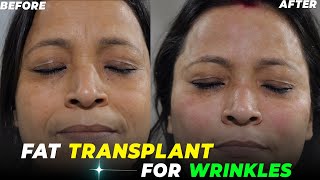 Say goodbye to wrinkles: The fat transplant solution | Fat Transplant For Wrinkles | Awish Clinic