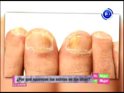 Por qué aparecen las estrías en las uñas? - YouTube