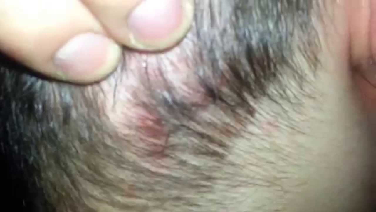 scalp acne - YouTube