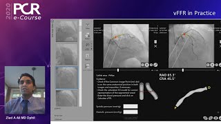 FFR wires passé? Rethinking the physiological assessment of coronary artery disease