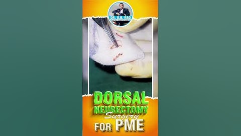 Dorsal Neurectomy Surgery for PME Relief | End Premature Ejaculation (PME) Struggles.