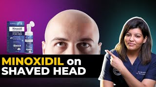 Minoxidil on a Shaved Head - Does it Work?  | Dr. Nandini Dadu (BIG REVEAL)