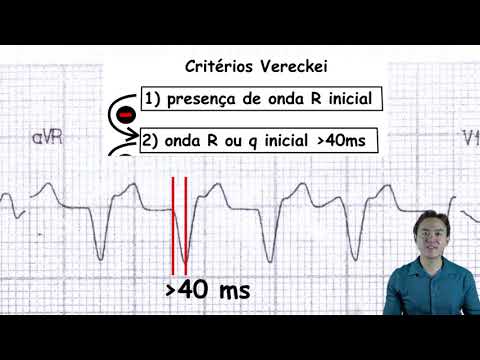 Vídeo: Estimulação Atrial Sincronizada Por Onda R Em Pacientes Pediátricos Com Taquicardia Ectópica Juncional Pós-operatória: O Intervalo Atrioventricular Investigado Por Análise Computac