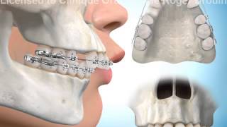 Extractions de dents pour correction surplomb horizontal screenshot 4