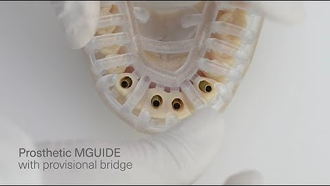 MIS Prosthetic GUIDE Tutorial: Guided Prosthodontics in Immediate Loading Procedures*