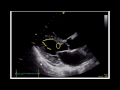 Estimating Ejection Fraction with Point of Care Echo