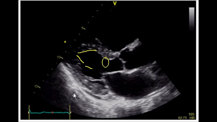 Estimating Ejection Fraction with Point of Care Echo