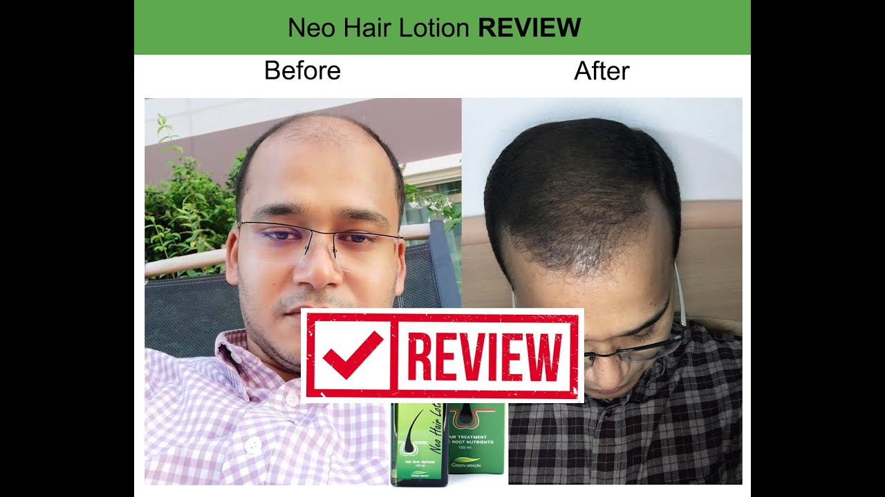 Neo hair lotion review 2021 *** Exclusive