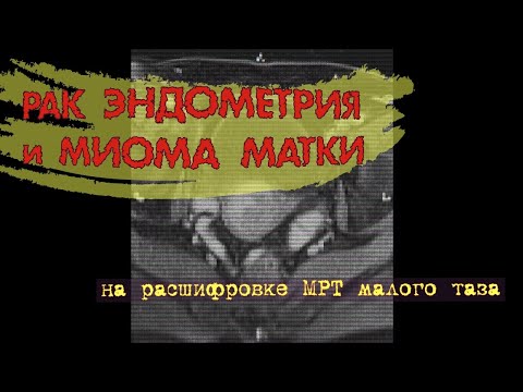 РАК ЭНДОМЕТРИЯ матки (симптомы) и миома матки на расшифровке МРТ малого таза