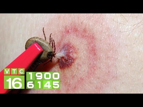 Video Cách phân biệt các loại vết đốt của côn trùng | VTC16 - youtube