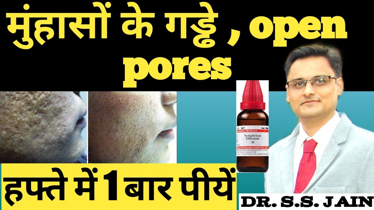 ACNE HOLES TREATMENT / मुहांसों के गड्डे भरने का अचूक नुस्खा /remove dark spots/black spots