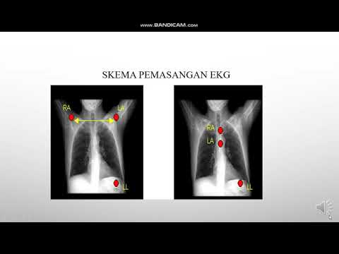 Video: Regresi Neovascularization Joltapapillari Choroidal Dalam Pelbagai Sindrom Dot Putih Yang Berwarna Putih Oleh Kaosogram Optik Tomografi Angiografi: Satu Laporan Kes