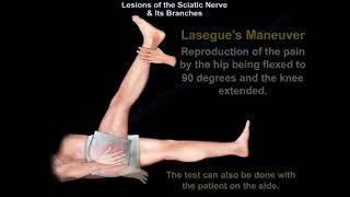 Lesions Of The Sciatic Nerve & Its Branches