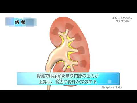 水腎症／ミルメディカル 家庭の医学 動画版