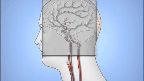 Diagnostic Cerebral Angiography