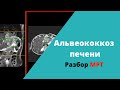 Альвеококкоз печени (разбор МРТ)