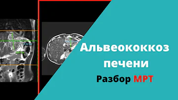 Альвеококкоз печени (разбор МРТ)