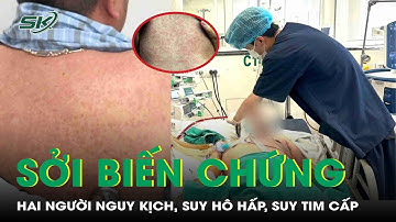 Hai bệnh nhân nguy kịch vì mắc sởi biến chứng viêm phổi nặng, suy tim cấp | SKĐS