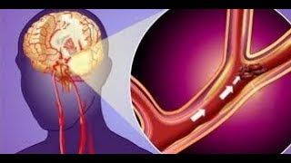 ★Первые признаки инсульта. Успей распознать. На счету каждая минута! Первая помощь при ИНСУЛЬТЕ. ★Первые признаки инсульта. Успей распознать. На счету каждая минута! Первая помощь при ИНСУЛЬТЕ.