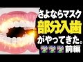 【観覧注意】ついにマスクとおさらば。部分入歯がやってきた【前編】