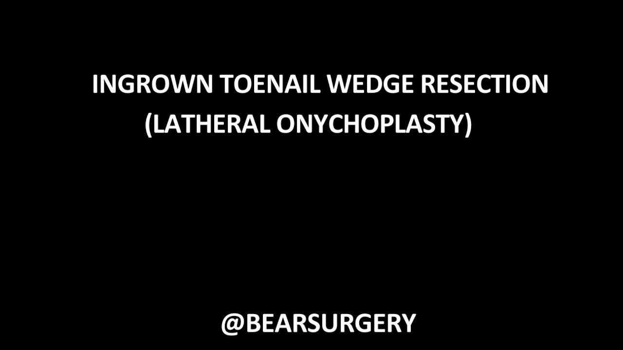 Ingrown Toenail Wedge Resection YouTube Ingrown Toenail Wedge Resection YouTube