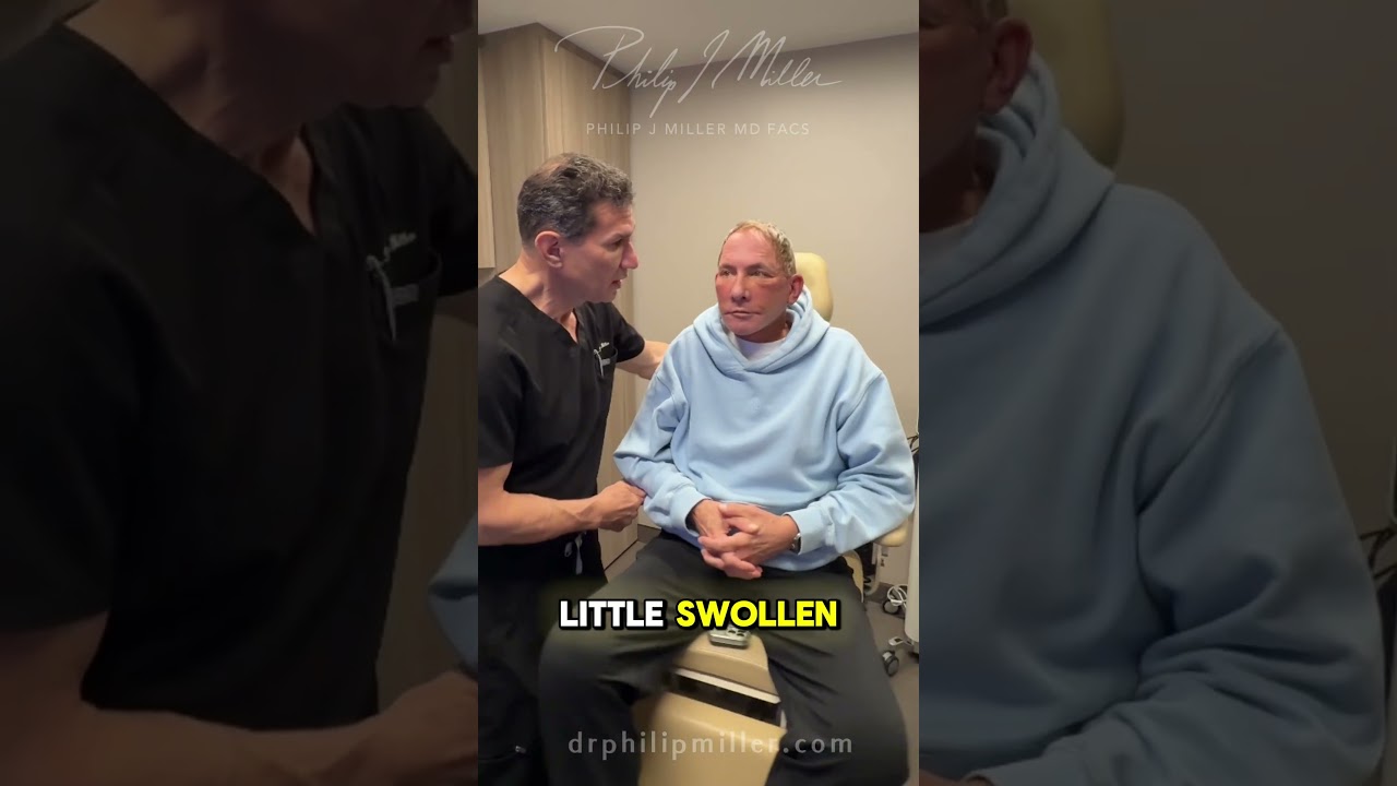 Day 6 Deep Plane Facelift & Neck Lift Result | Submandibular Gland Removal Explained