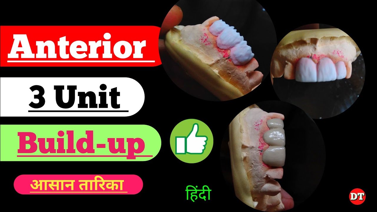 Upper 3 Unit Build up Ceramic Build porcelain ceramic Laboratory