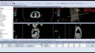 Halcyon Treatment Planning - Breast Irregular Surface Compensator