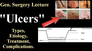 Ulcers- General Surgery Lecture| Classification,Etiology,Treatment, Complications!BDS/MBBS Lecture