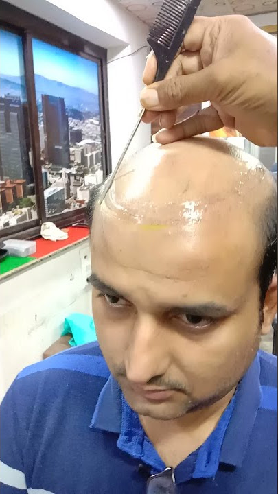 Cheapest hair patch in Mumbai 2499 only 9075156688