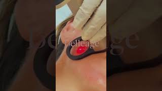 Hybrid laser in Belleagé #aestheticmedicine #contentcreator #beauty #wellness #nursecreator