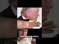 What’s the rash on President Trump‘s neck? For general educational purposes only.#rash#trump#doctor