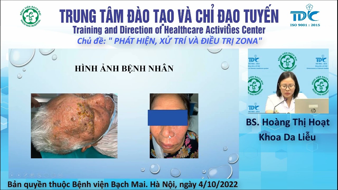 Phát hiện, xử trí và điều trị Zona