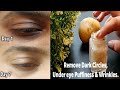 I Removed DARK CIRCLES in 7 Days with Potato Eye Gel|Remove under Eye Circle,Wrinkles & Puffiness.