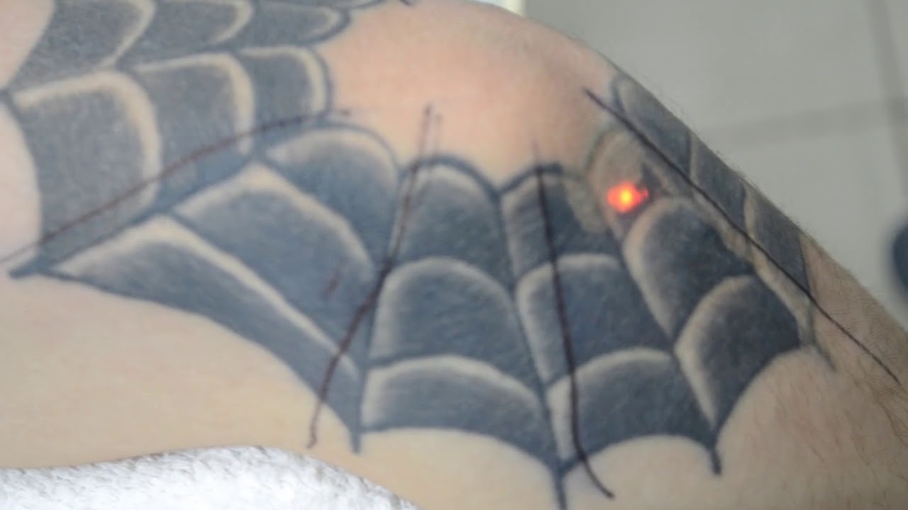 Удаление татуировок лазером Ростов на Дону - YouTube