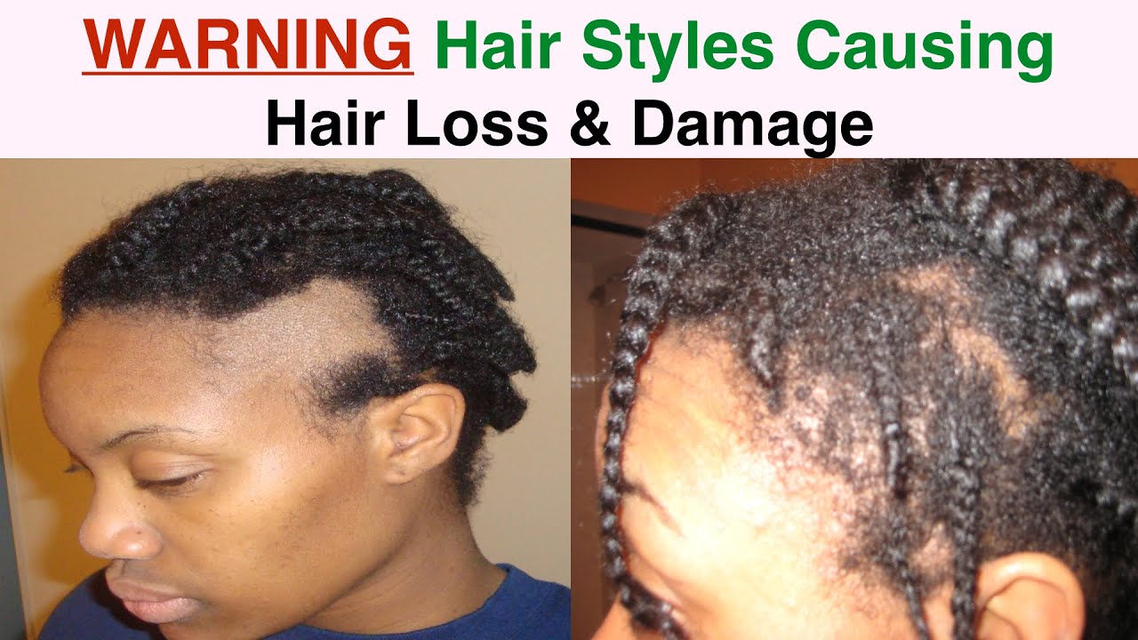 Traction Alopecia - How to Prevent Further Hair Loss and ...