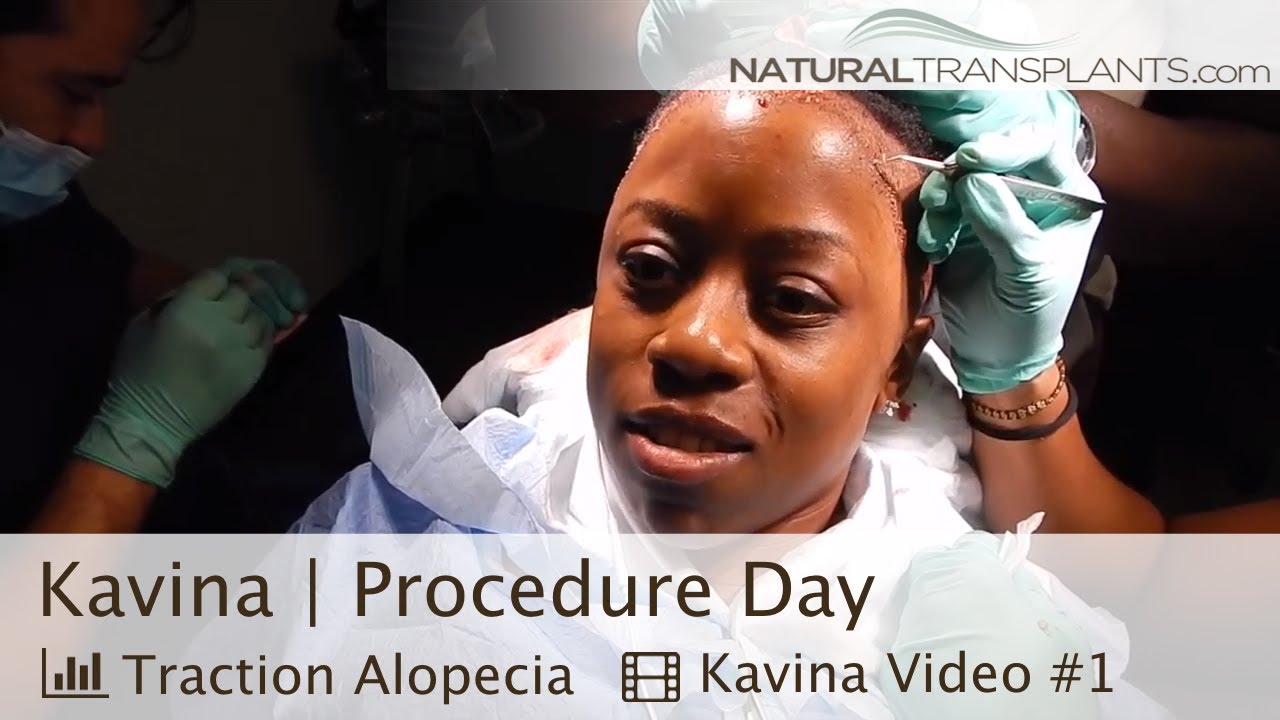 fue hair transplant month by month African American Hair Transplant | Hair Transplant Women (Kavina)