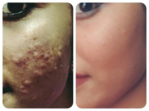 how to get rid of pimple/acne/rashes over night? (remove pimples in  hours)