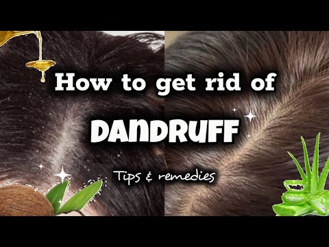 How to get rid of DANDRUFF | causes, tips & remedies | Har care tips | Home Remedies
