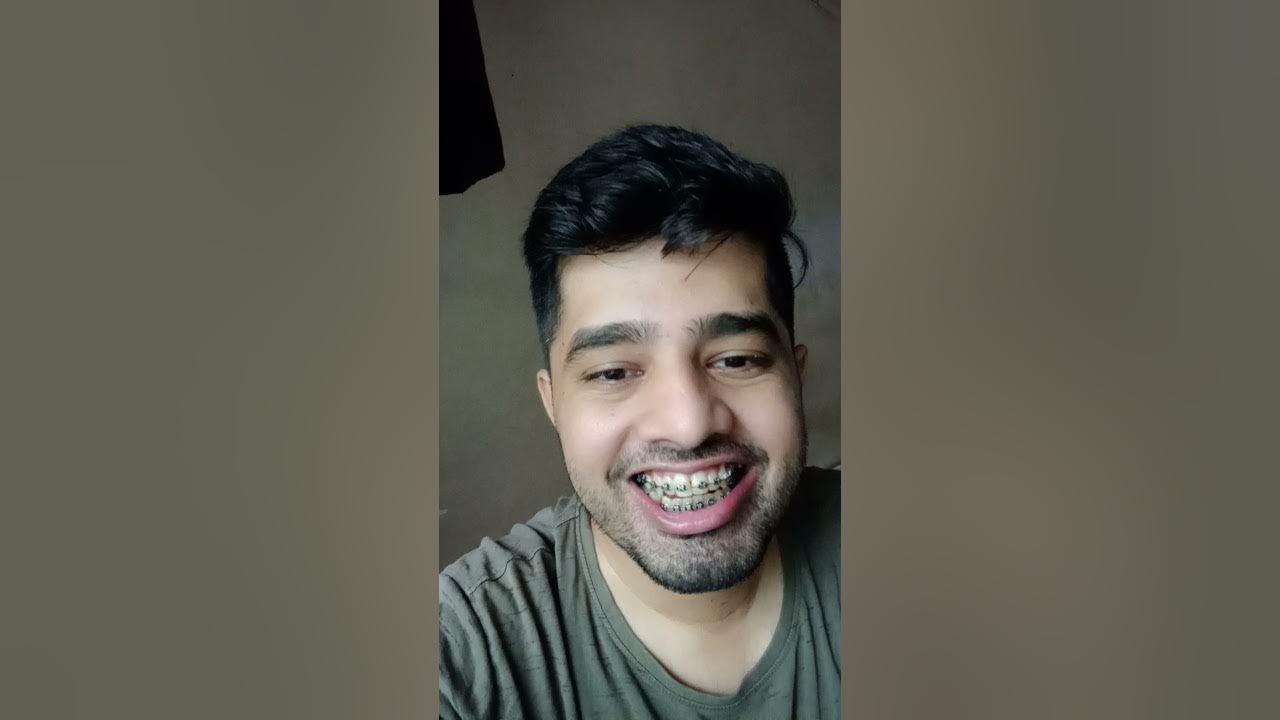 Braces journey process !3rd month from changing wire YouTube
