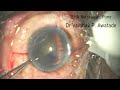 Phaco , Direct Chop , Toric IOL , 26/05/26
