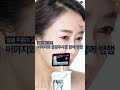 리프팅 보톡스를 하면서 찰떡궁합인 시술이 있다?! | 파인드피부과 황종익 원장