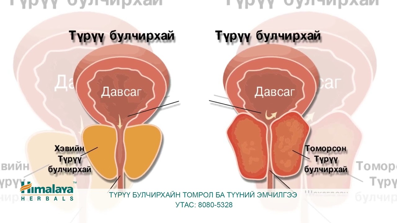 Түрүү булчирхайн томрол ба түүний эмчилгээ