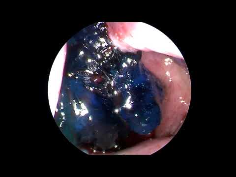 Endoscopic Repair of CSF Rhinorrhea_2018 04 02 _αντιμετώπιση εγκεφαλονωτιαίου υγρού