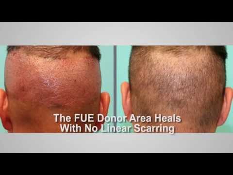 Advantages of FUE
